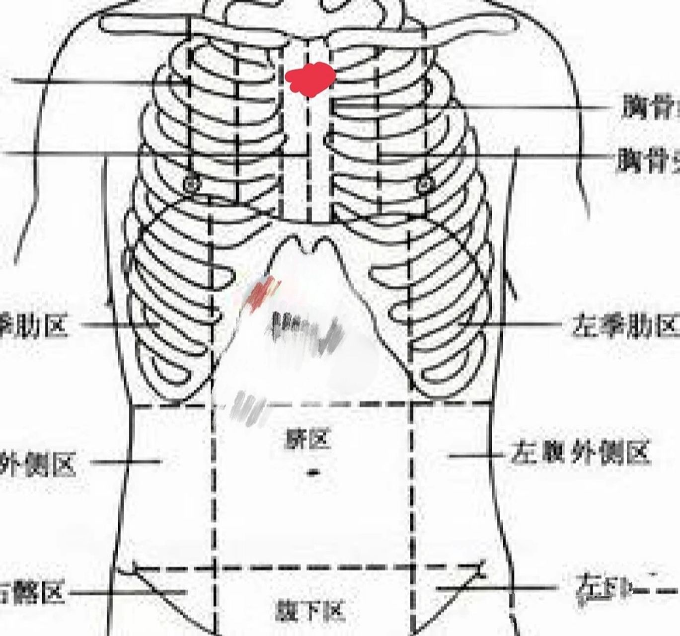 胸口骨头疼和对应后背面的骨头疼 胸口如图红圆点位置处痛,以及对应的