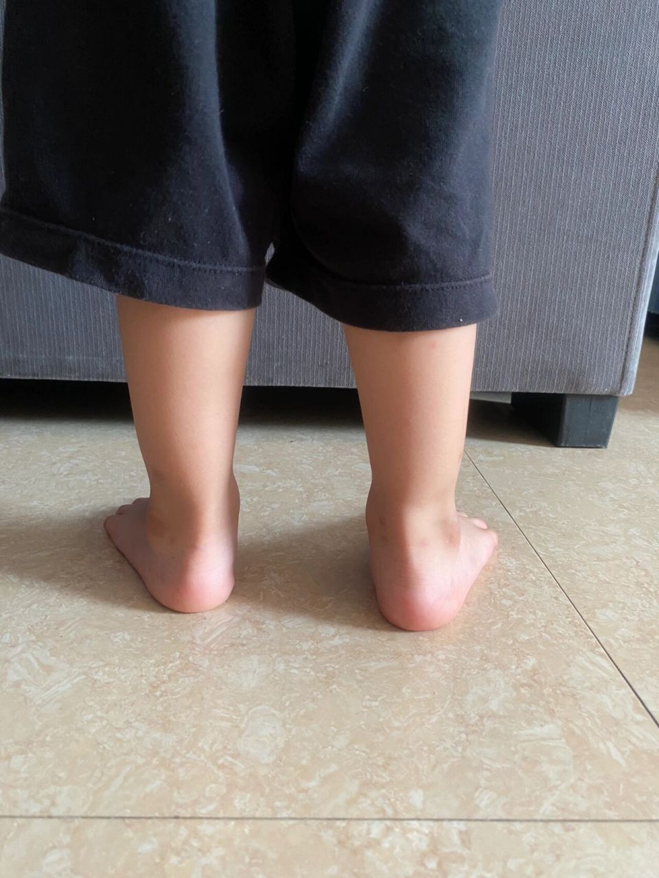 宝宝足跟外翻 平时只知道宝宝是平底足,无意间发现宝宝的足跟外翻🥸