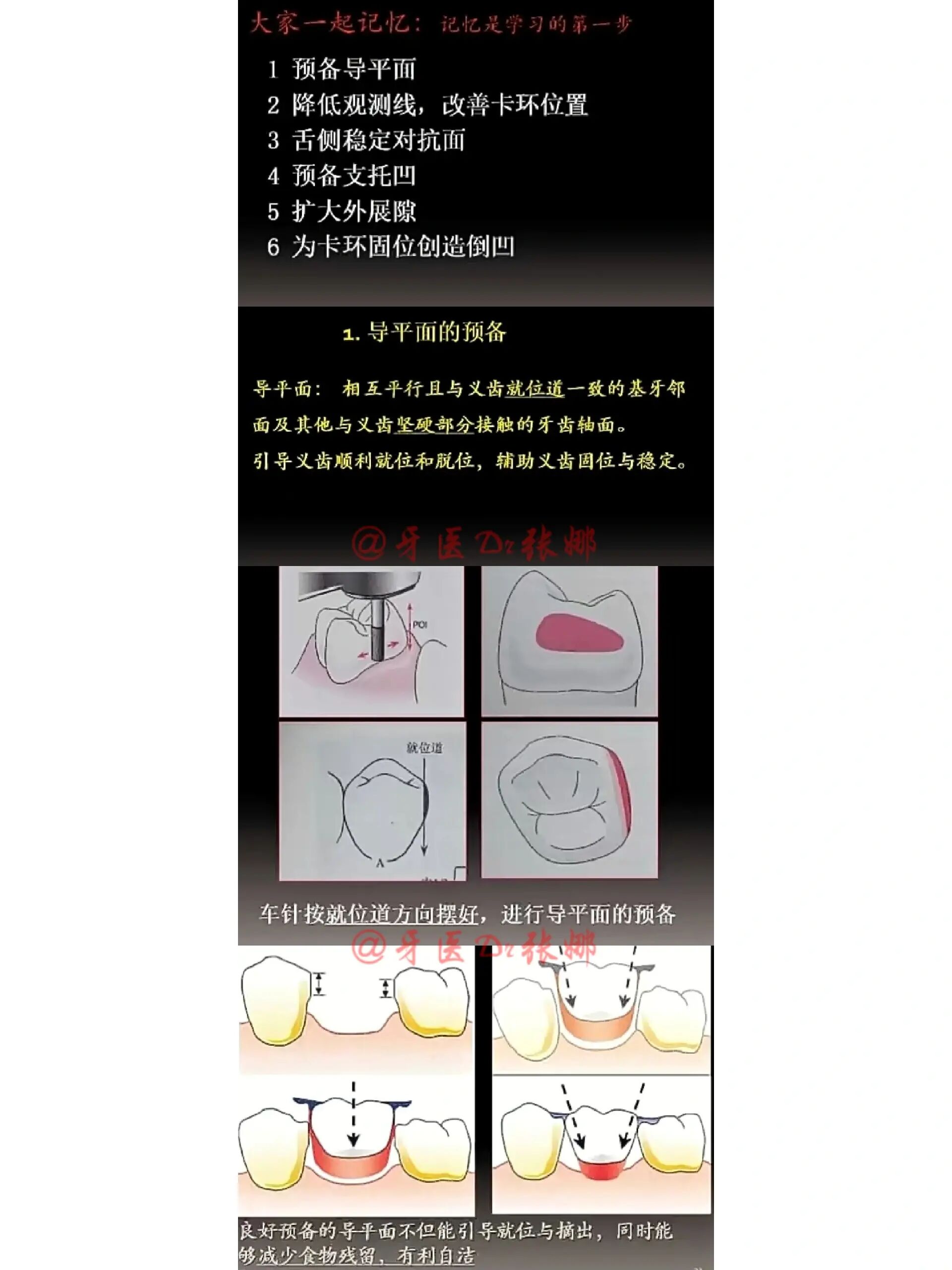 为卡环固位创造倒凹 学有所