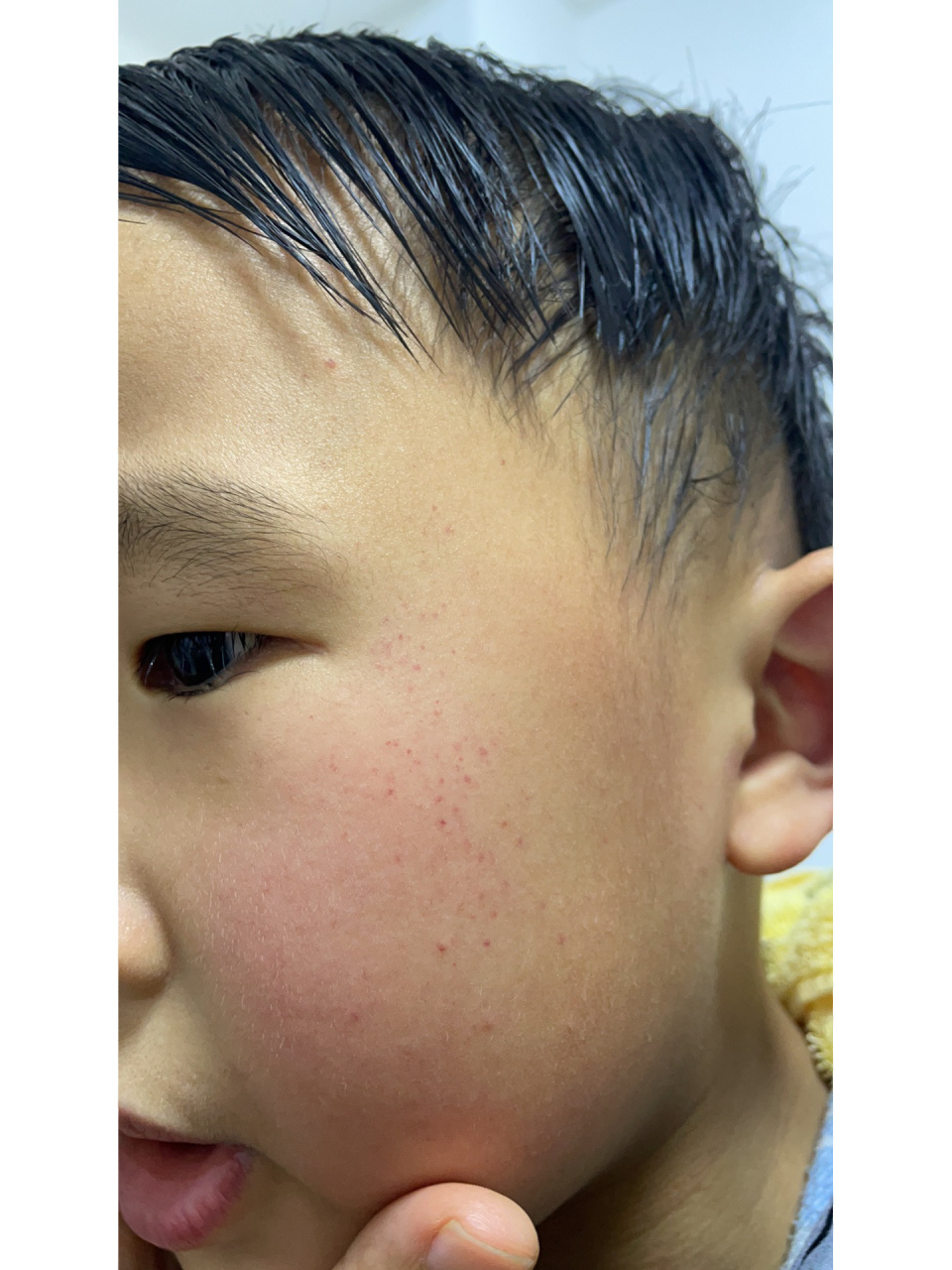 孩子脸上突然有这种红点点. 只有脸上有,不疼不痒的.