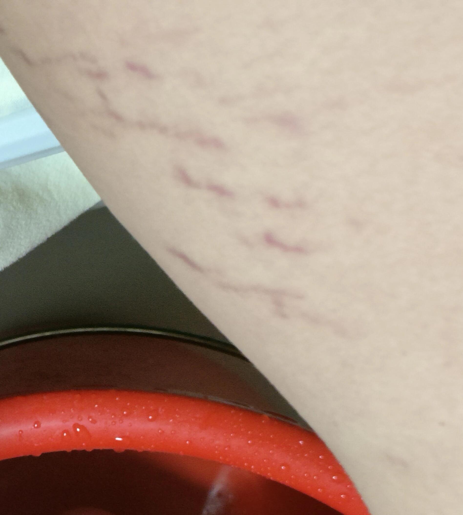 这种是肥胖纹吗? 有没有姐妹有同样的纹呀  大腿内侧的