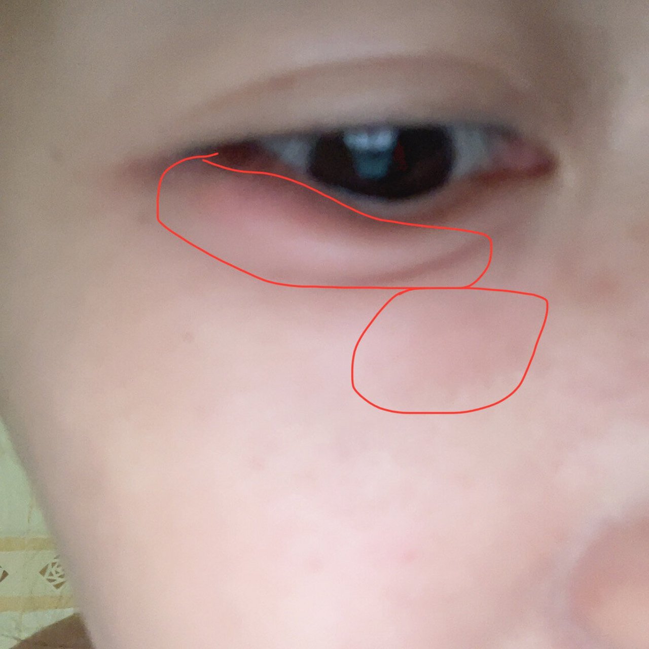 下眼睑红肿疼 真的是上了年纪一上火就来毛病,周一开始眼睛下面开始疼