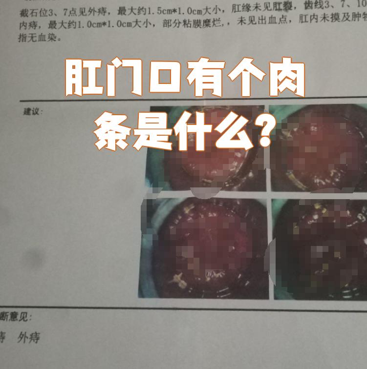 肛门口长了个肉条,最常见的原因是外痔或肛门息肉
