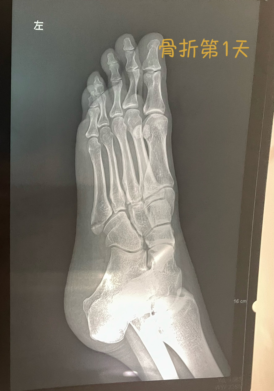 第五跖骨骨折1个月 从2月13到3.14,骨折30天了,满一个月了.