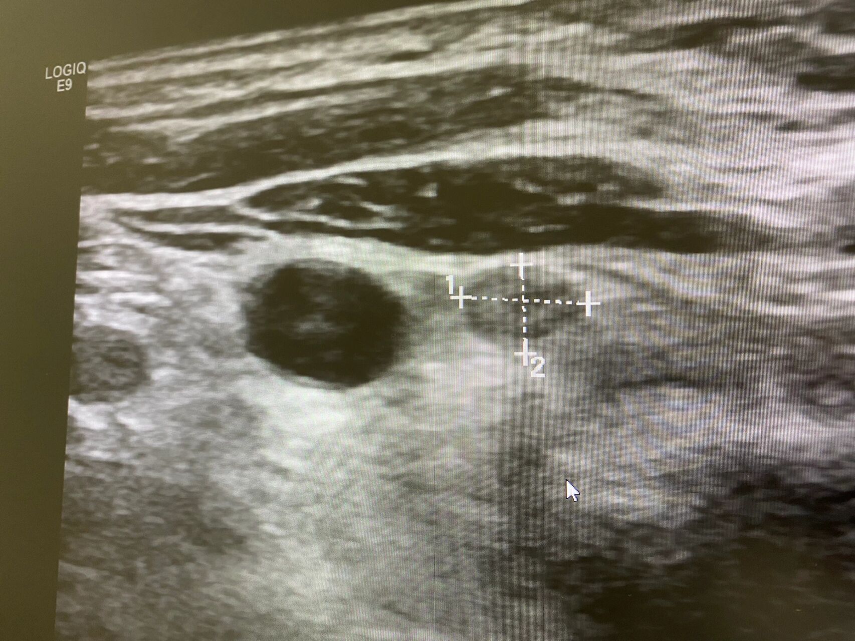 记录一个b超观察下的淋巴结