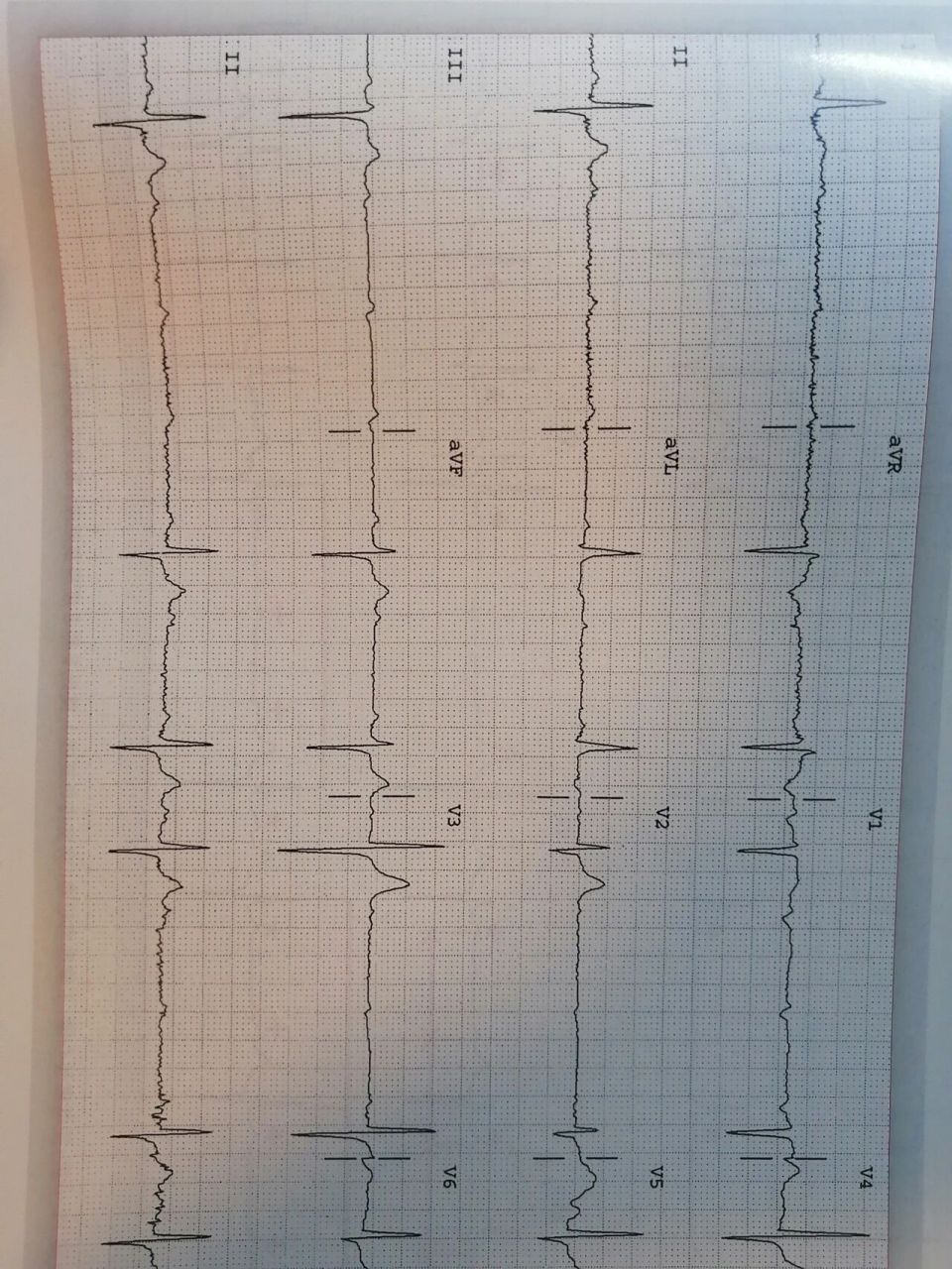 心电图辨认1 1.一度房室传导阻滞:p-r间期>0.12s,通常临床无症状. 2.