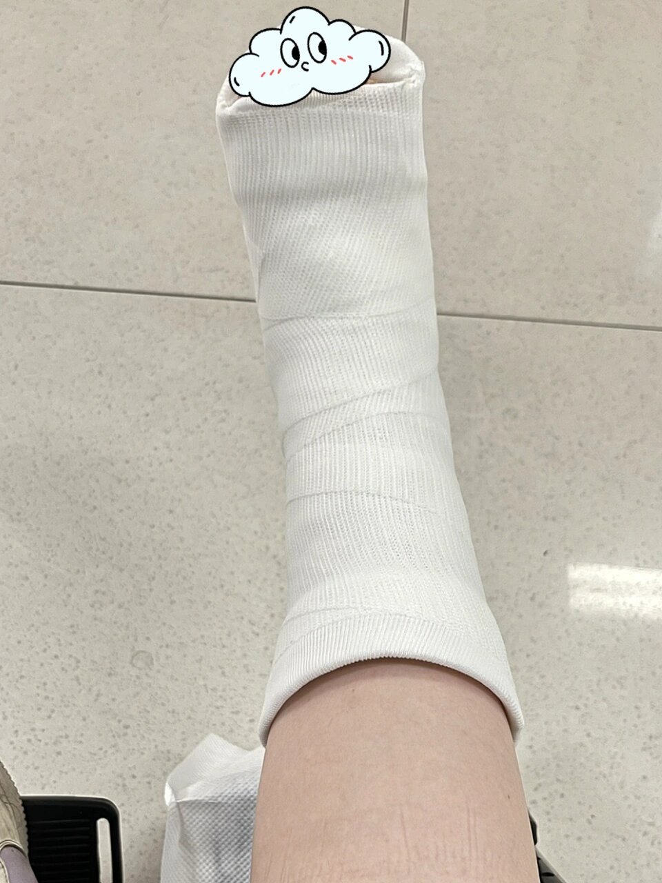 今天去医院复查,骨折的位置没有移位,妥妥的不用手术,换长期石膏