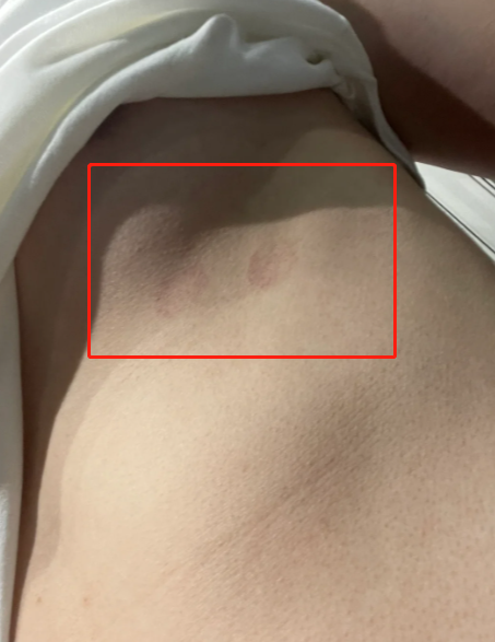 胸下面出现红色块状物,常见原因包括体癣,压力性紫癜和花斑癣