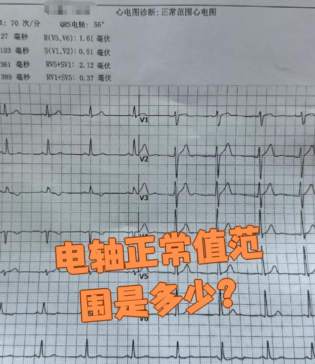 心电图的电轴正常值范围是