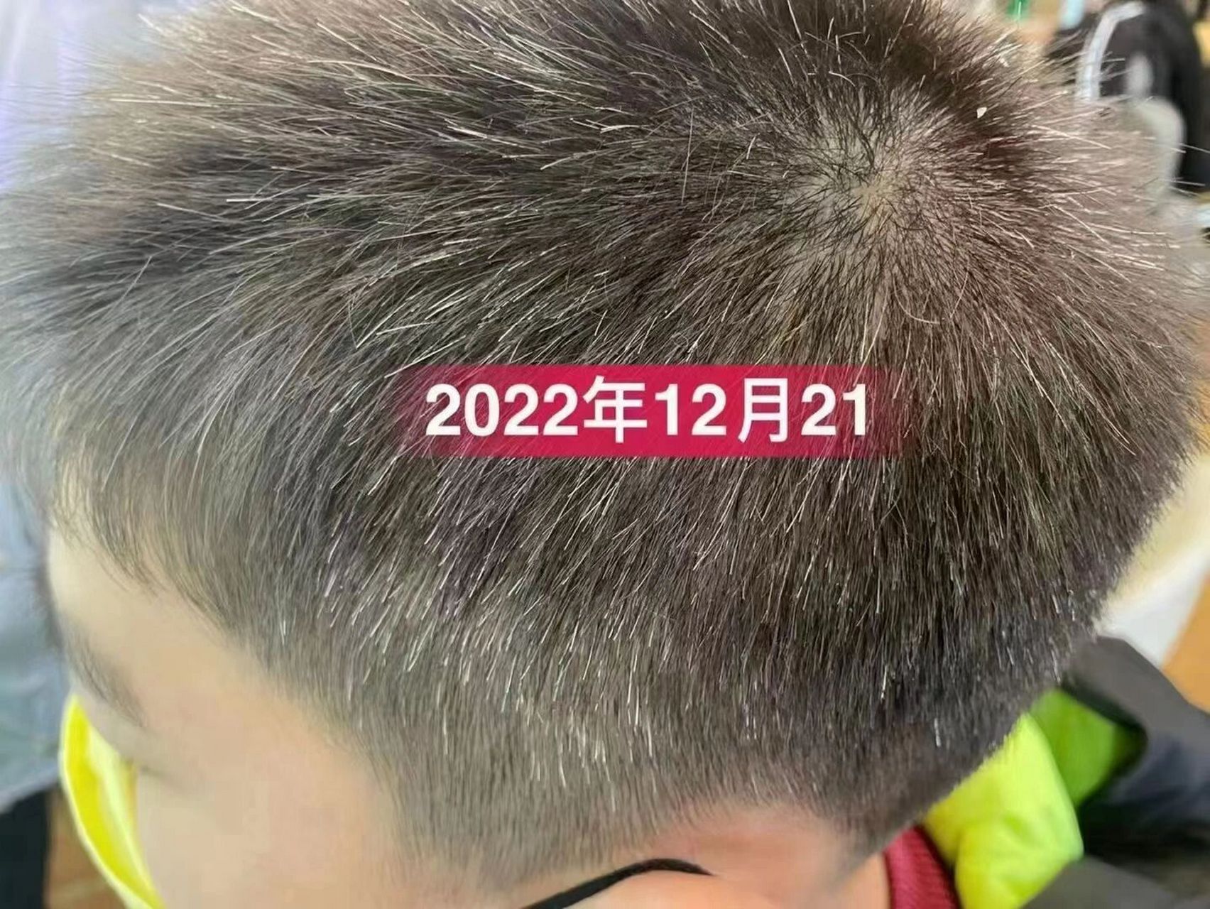儿童白发不要忽视97 7115儿童长白头发的原因有以下几点: 一