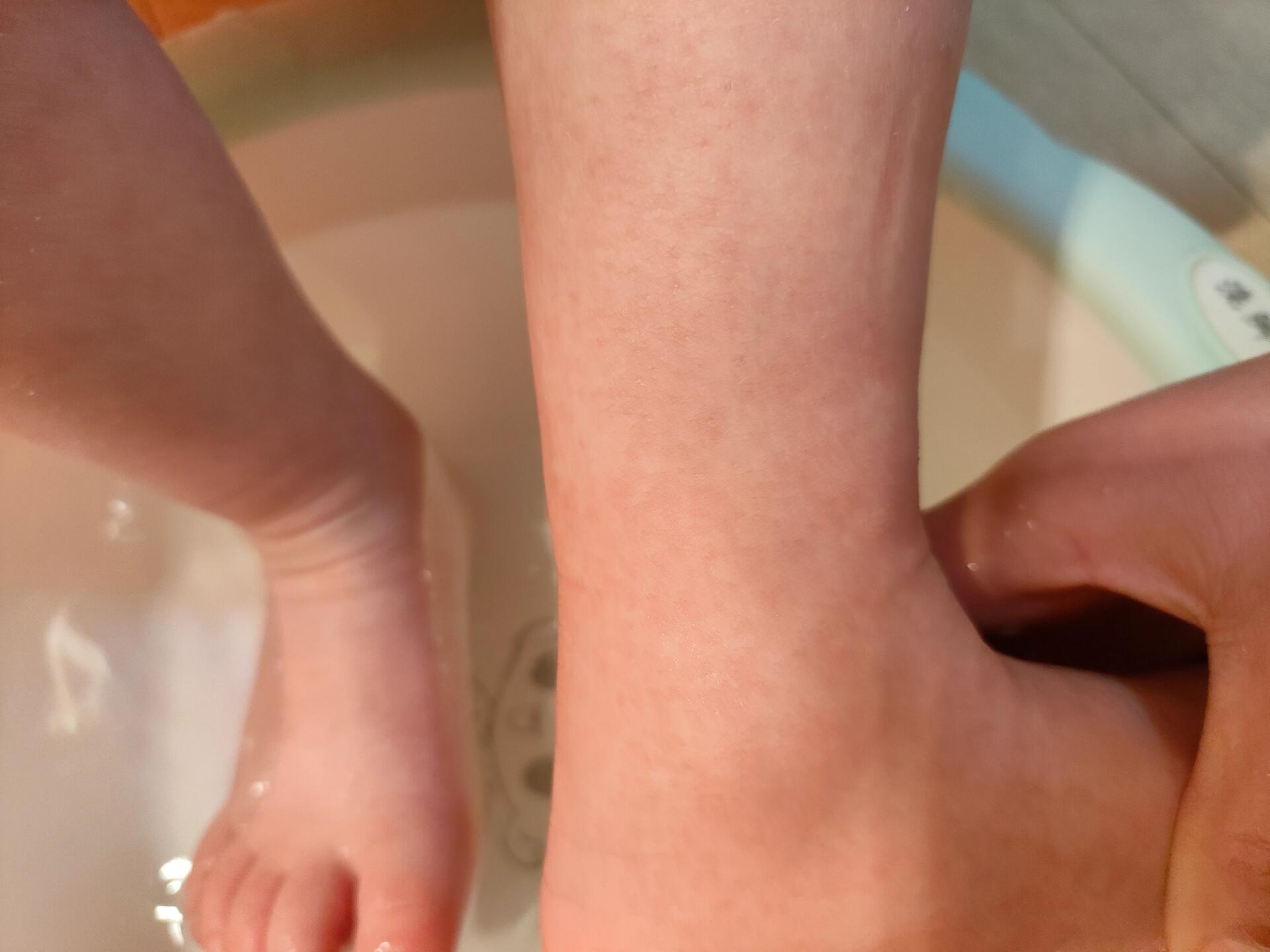 宝妈们看过来-肺炎后出疹 前段时间因为肺炎住了一个