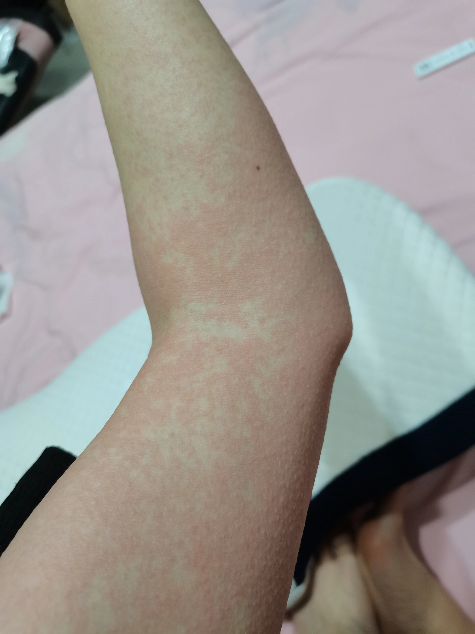 发烧阳后,全身红疹