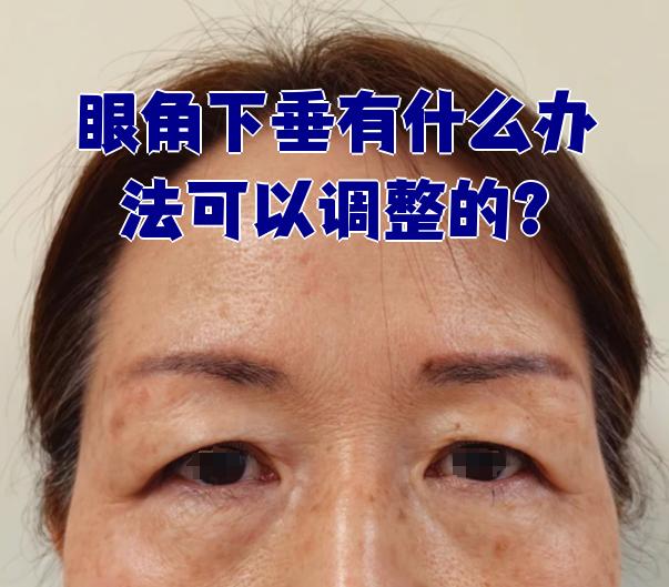 眼角下垂可以通过不同方法来调整,具体要看是什么原因引起的