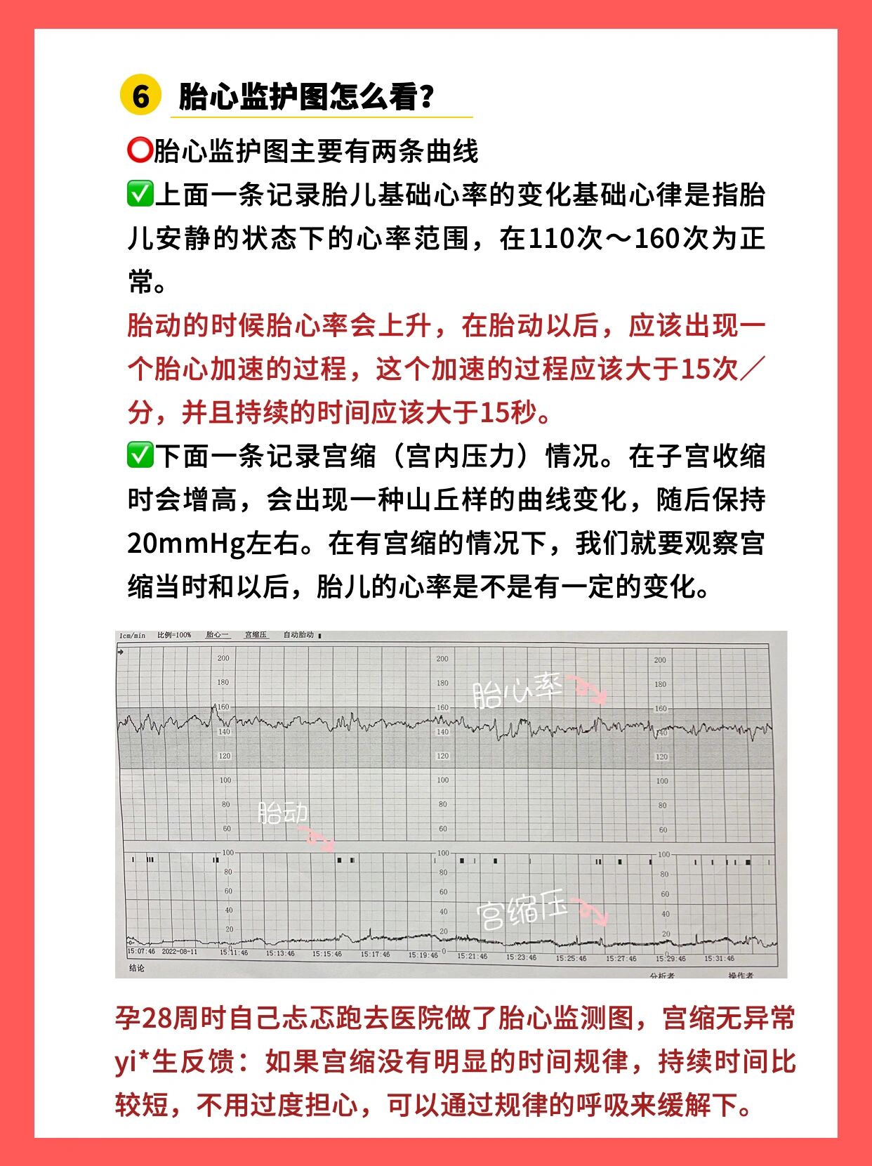 胎心监护是用胎心监护仪对胎儿的胎心率和宫缩进行监测
