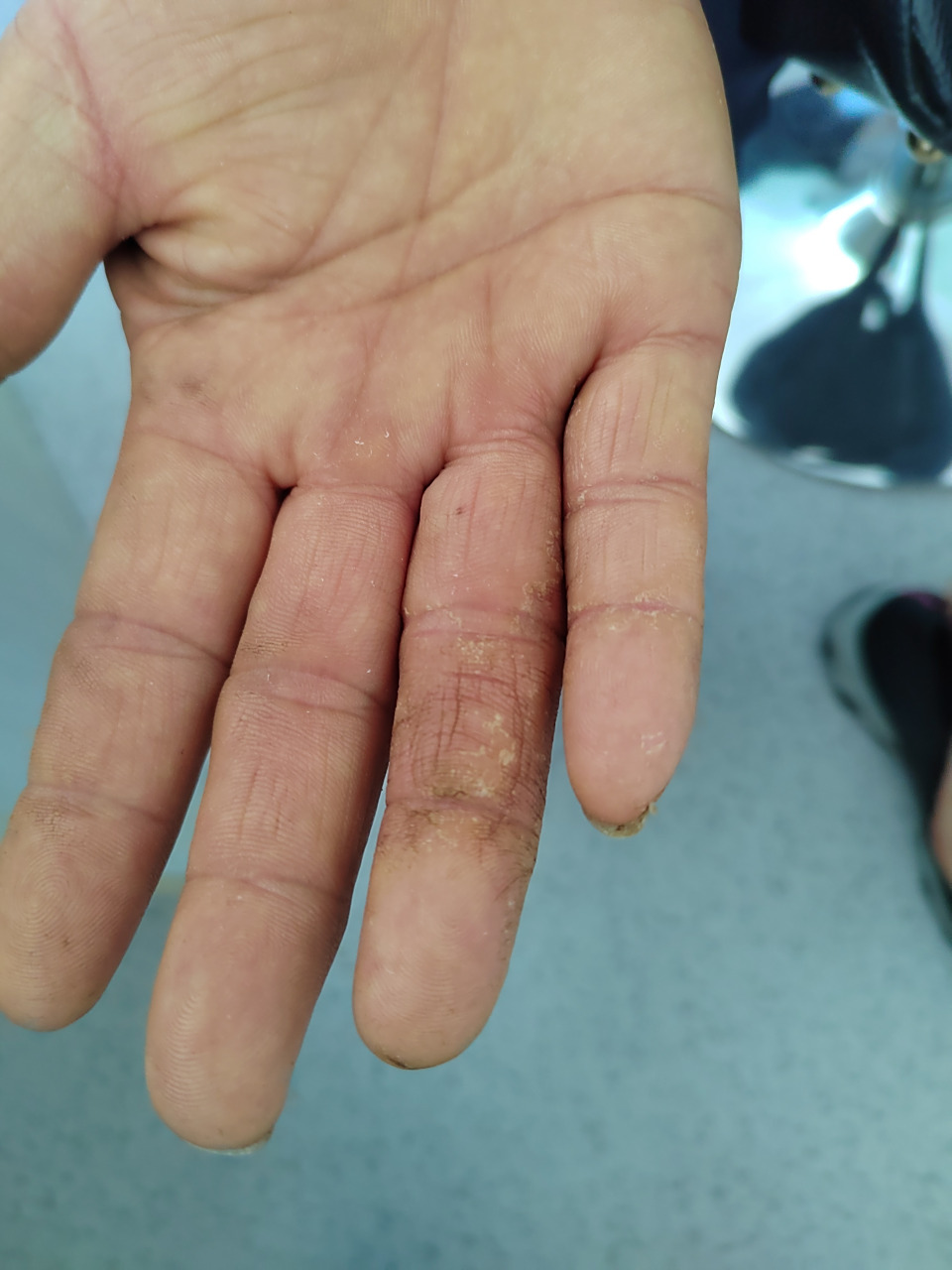 手掌干燥肥厚裂口症状.考虑慢性湿疹,接触性皮炎症状#过敏##皮肤