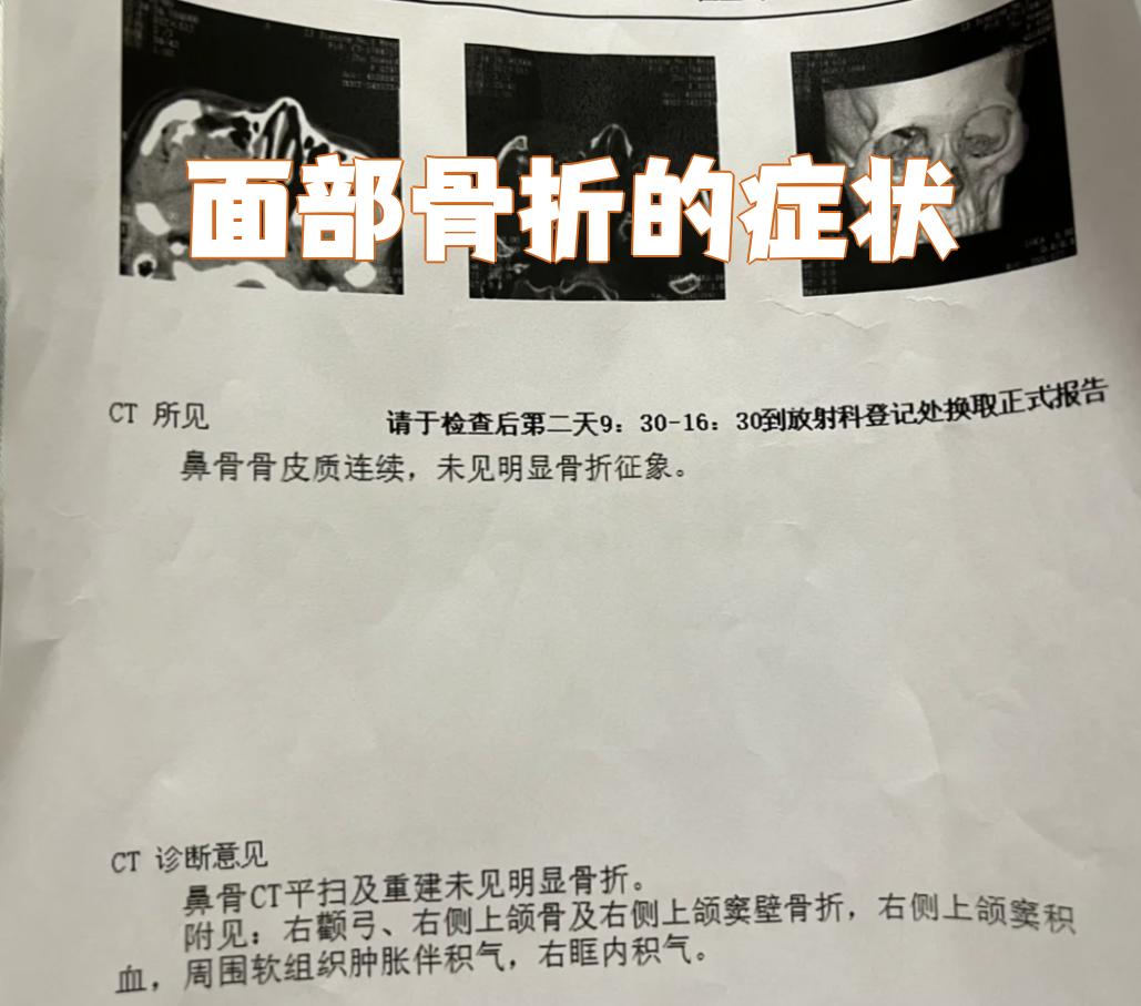 颧骨骨折,上颌骨骨折和下颌骨骨折,不同部位的骨折症状各有特点