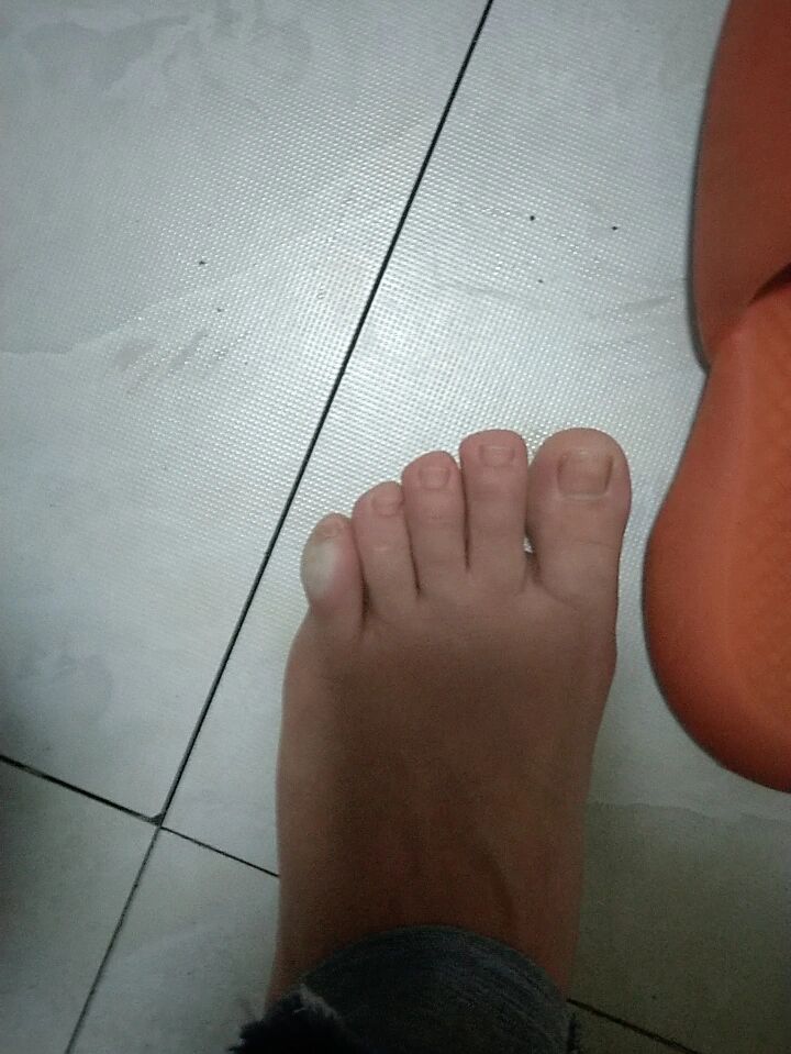 小脚趾外翻 不管穿什么鞋子时间长了小脚趾侧面都会磨到
