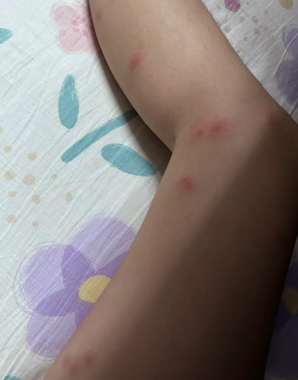 但也可能是蚊虫咬的,或者是汗疱疹,湿疹,毛囊炎这些皮肤病引起的