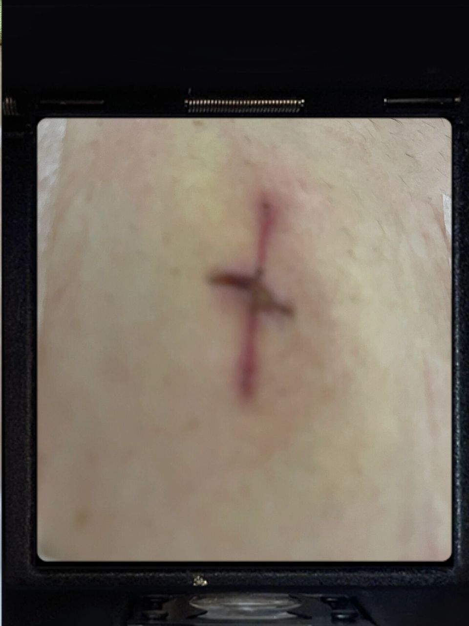 阑尾手术第八天,拆线啦 术后第八天,昨天去拆线了,三个洞,这个伤口比