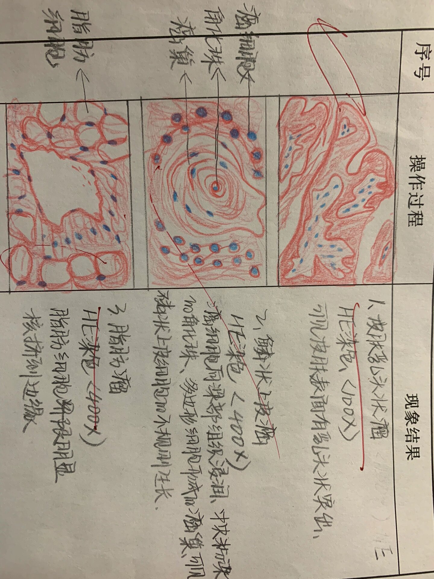 病理切片(皮肤乳头状瘤,鳞状上皮癌,脂肪瘤)