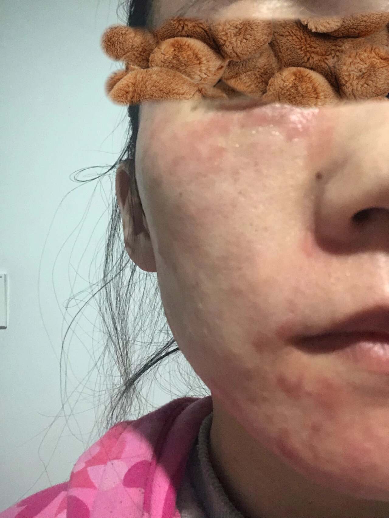 医美水光针 到底是麻药过敏还是灼伤? 第一次做水光针.