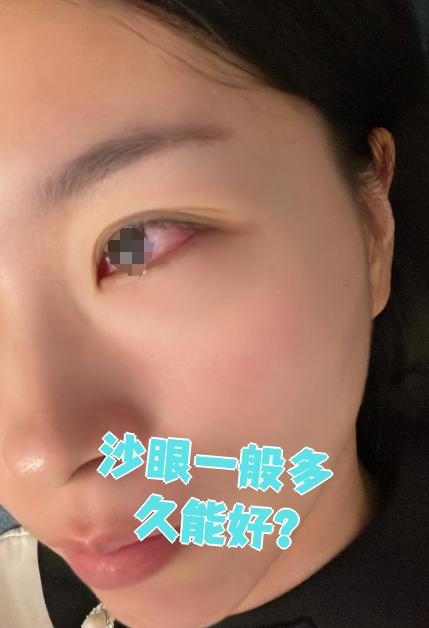 沙眼的恢复时间通常在3