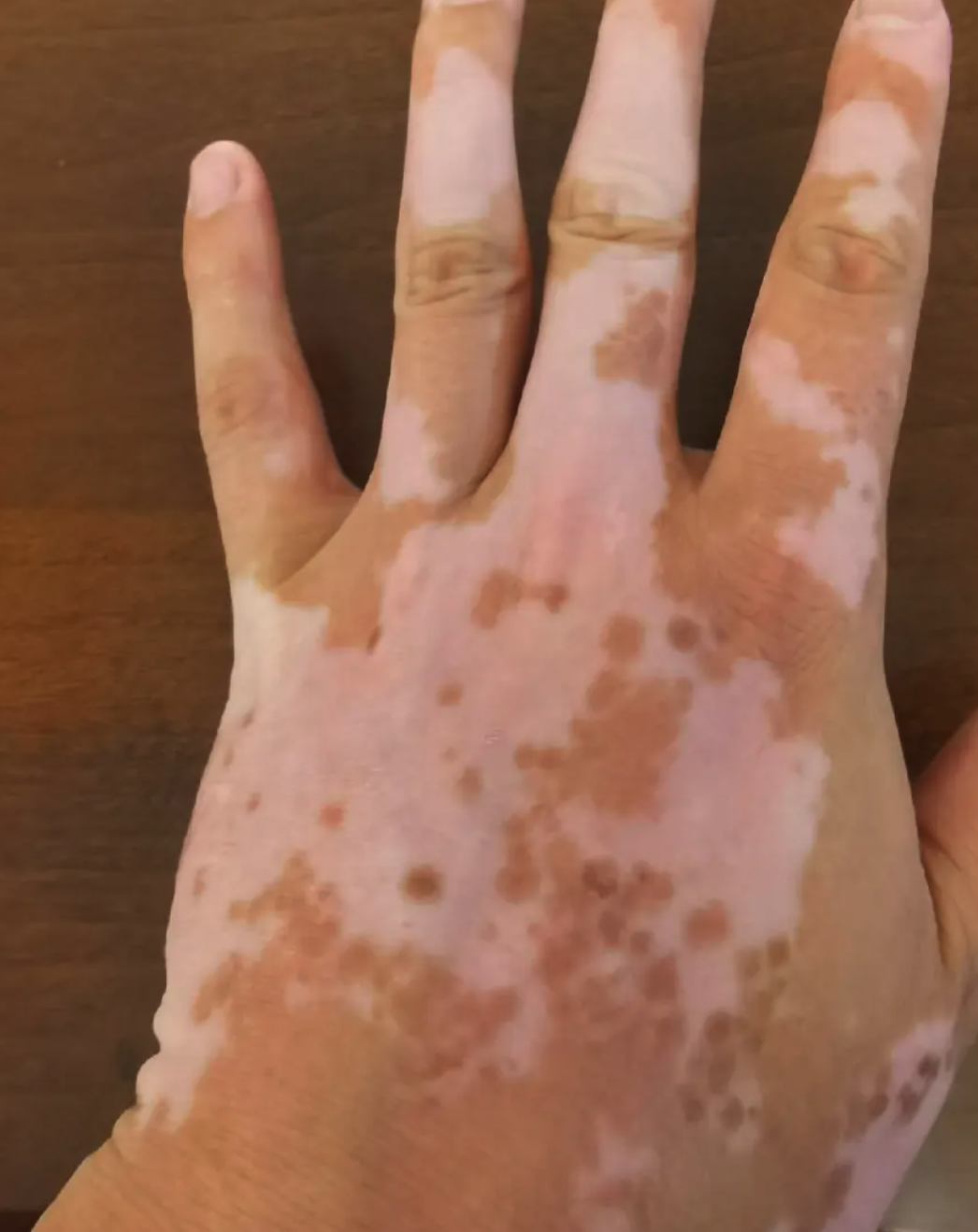 皮肤出现一块块白斑,最常见的原因是过度摩擦或白癜风