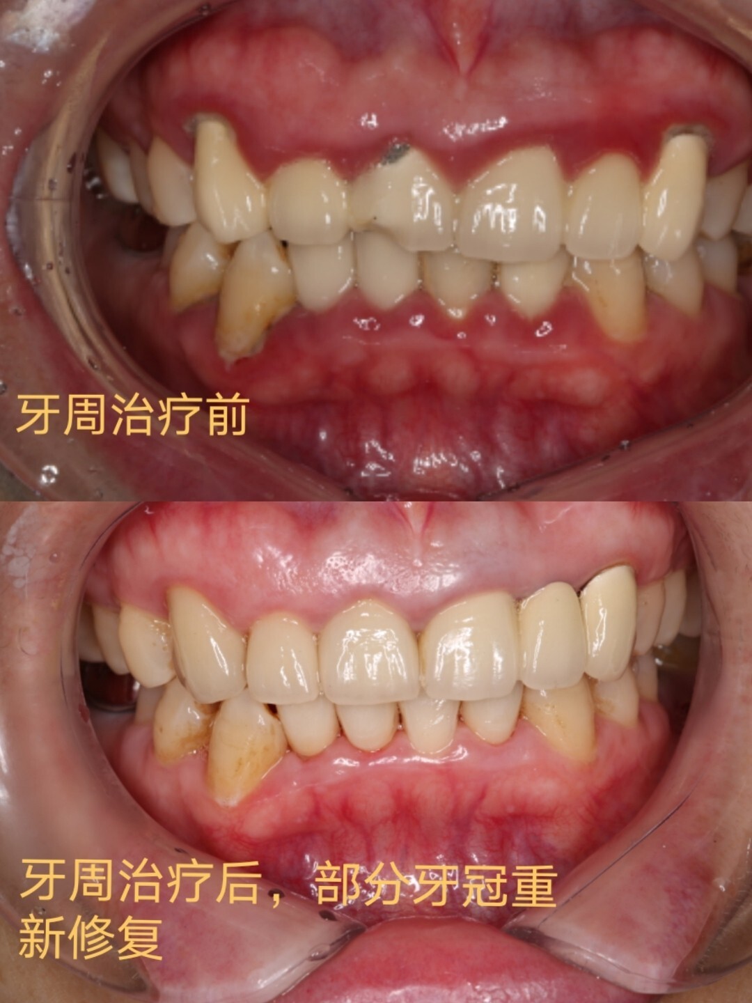牙龈红肿有多影响你的美 图一这个小姐姐牙龈非常红肿,刷牙出血,不敢