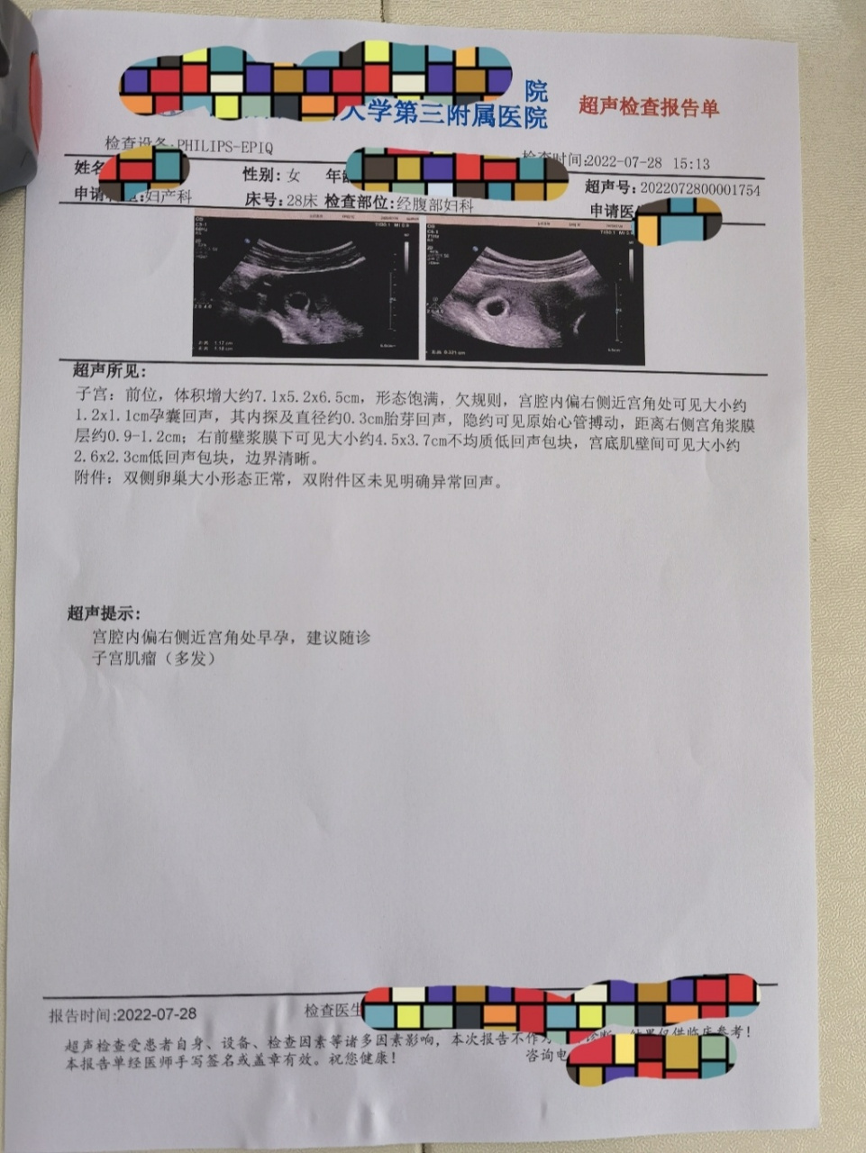 【疑似宫角妊娠】 自测两道杠,7月22号因褐色分泌物增多去医院检查