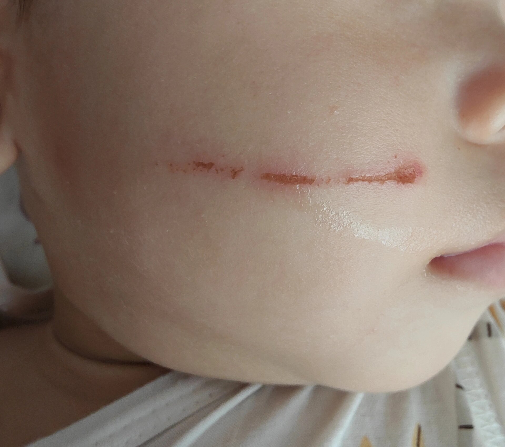 求问宝宝脸被指甲抓伤 怎么不留疤 宝宝脸被指甲抓破了,求问怎么护理