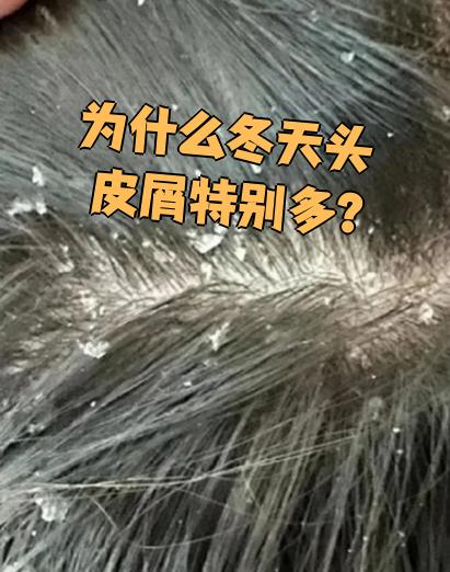 头皮屑为什么多 头皮屑为什么多