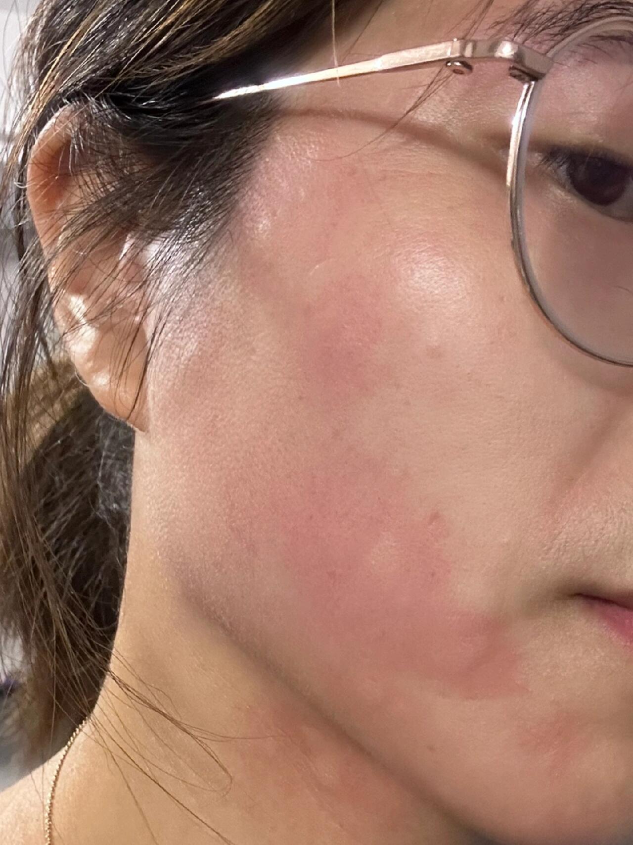 吃了虾跑步出汗后脸上和脖子上起了红疹子 之前跑步