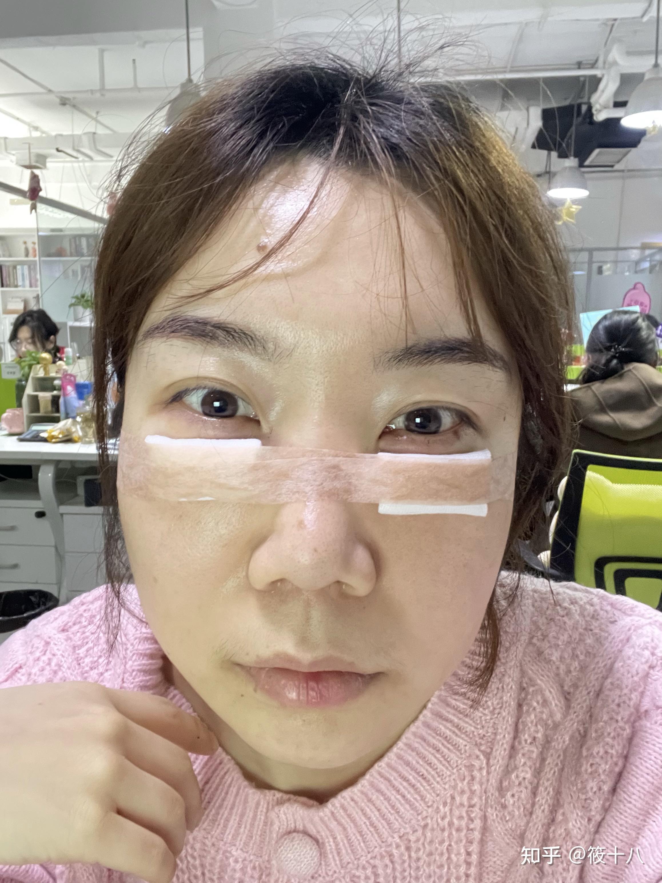 内吸无痕微创去眼袋