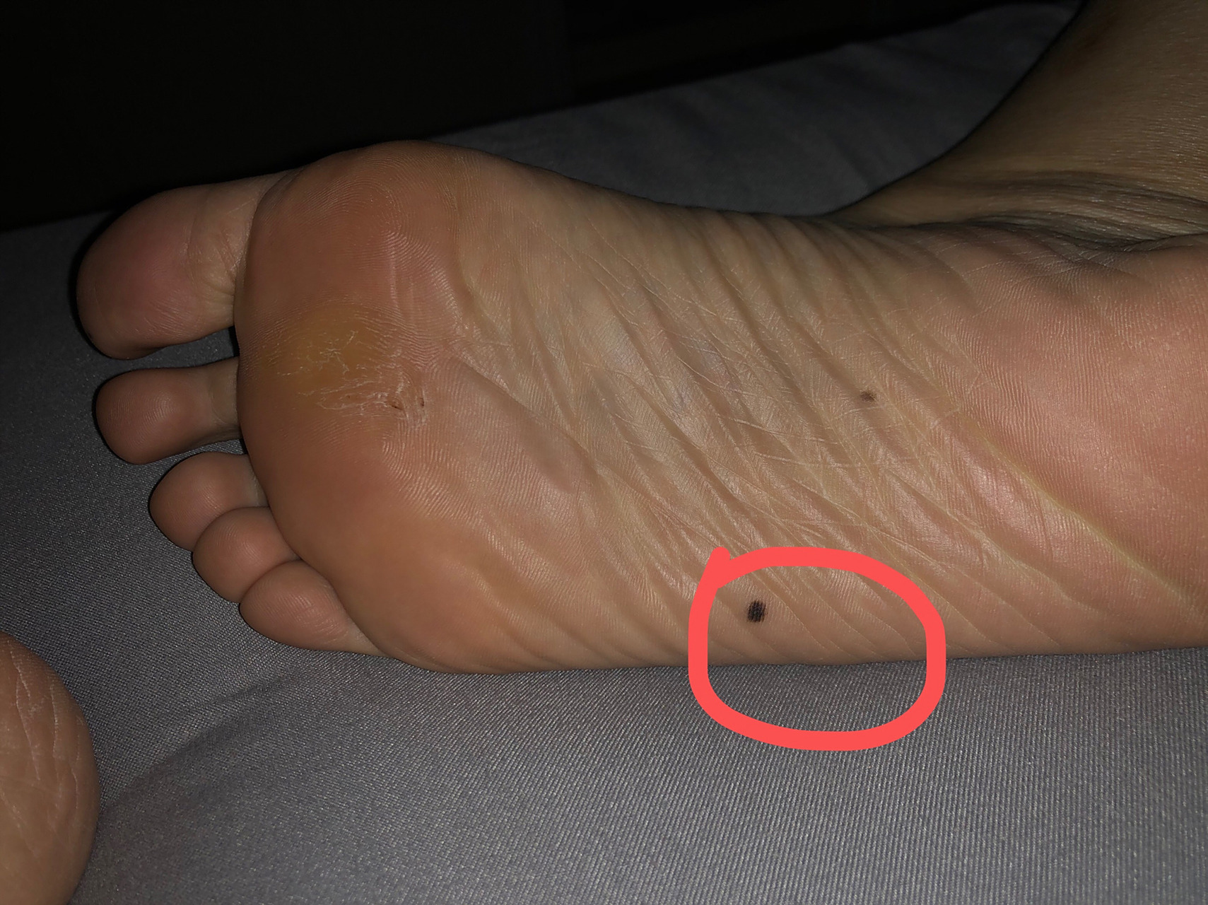 脚底板突然长痣 这颗痣应该是最近两三年长出来,感觉越来越黑,越来越