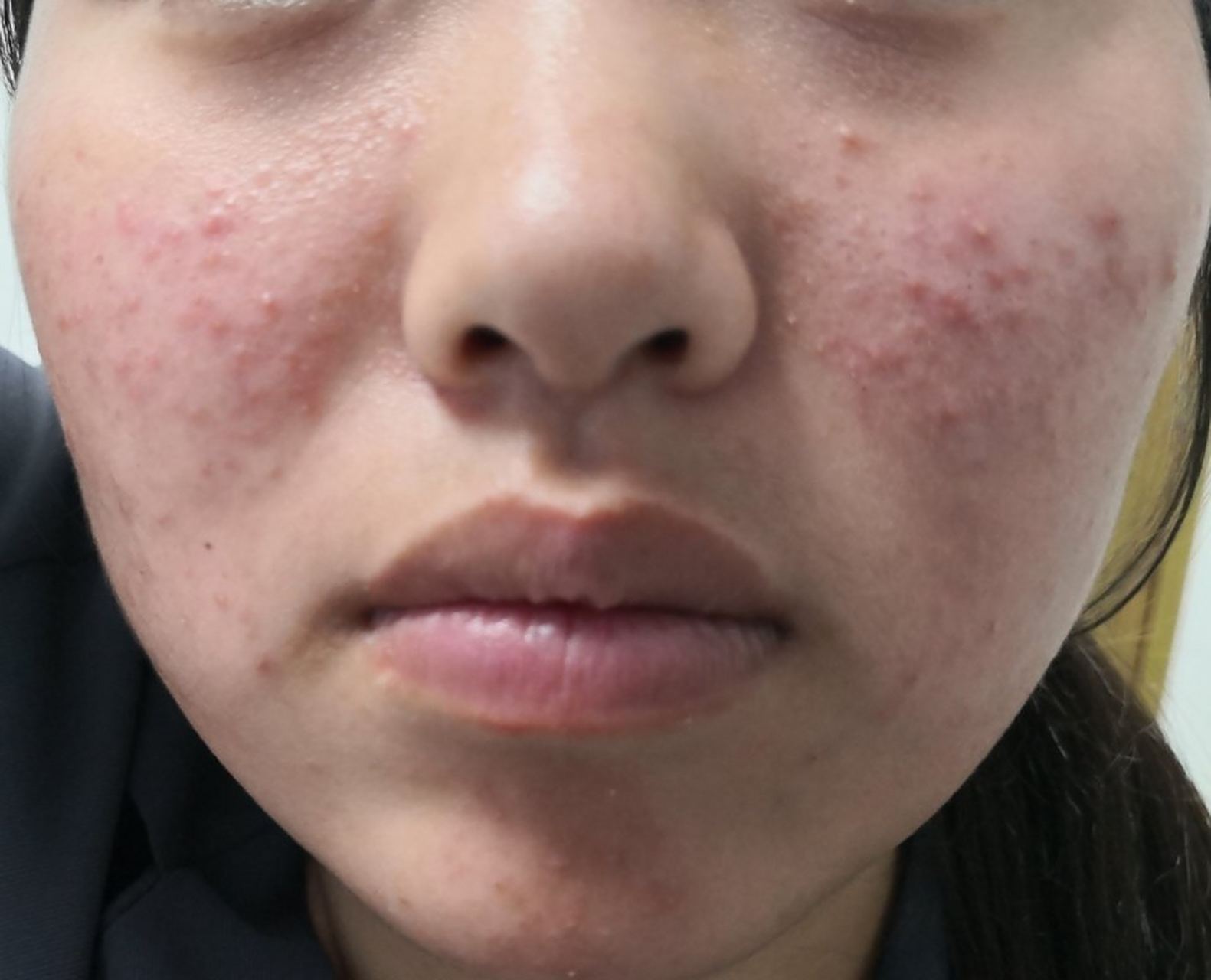 解决皮肤问题专注皮肤美容##痤疮