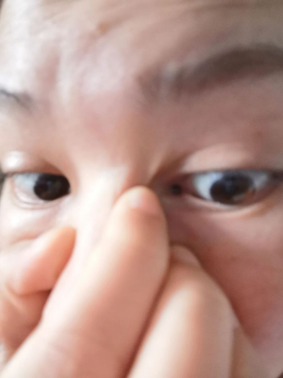 今天成功切除内眼角色素痣 写给有需要的姐妹们,我这颗色素痣是长在