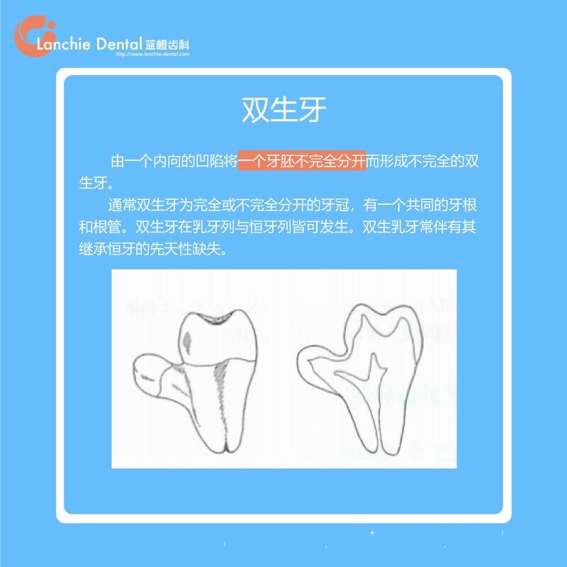 融合牙,双生牙,结合牙是个什么鬼?