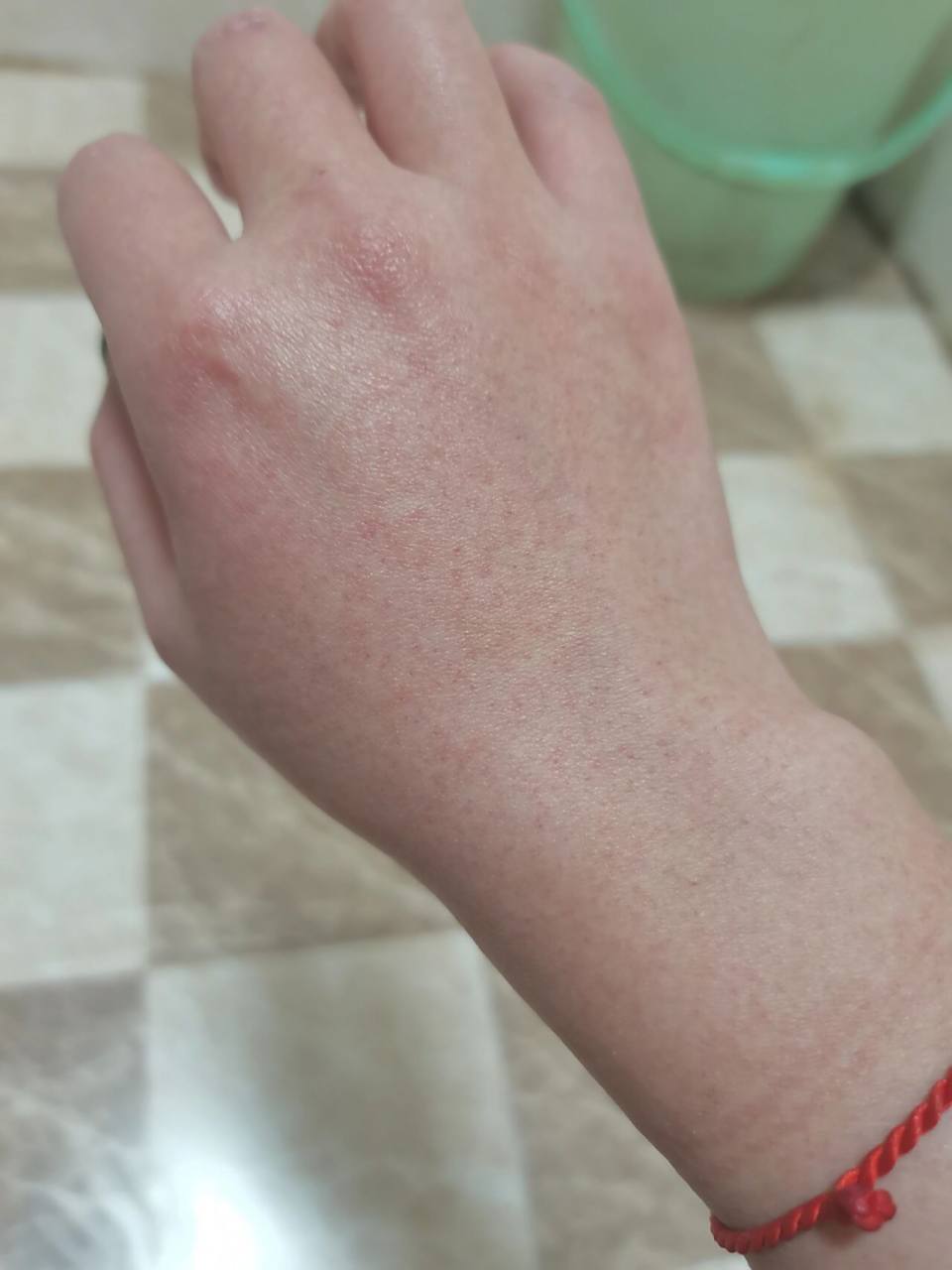 布洛芬过敏 家人们,咱就是说我好像对布洛芬过敏 	 周六下午开始有