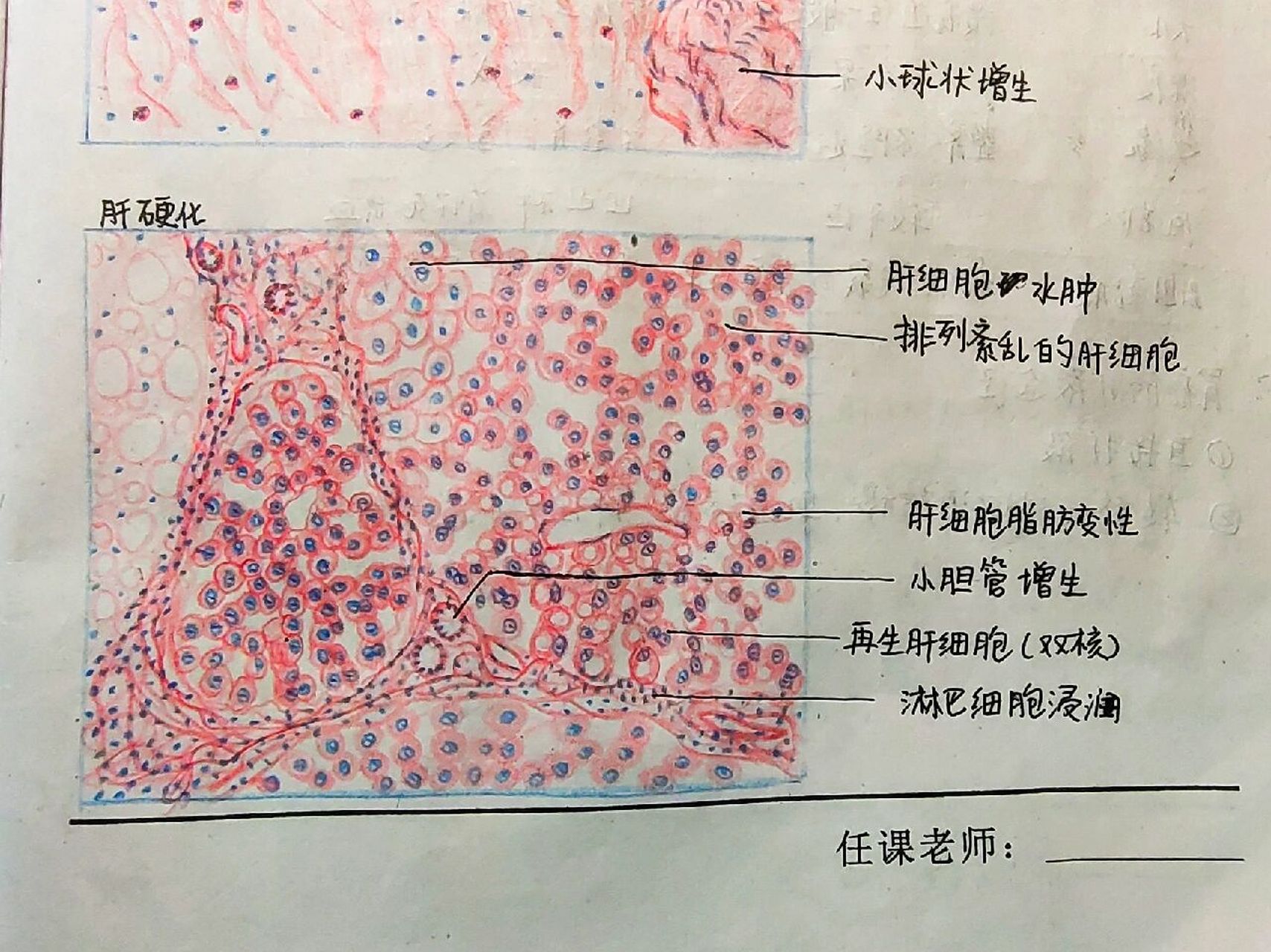 肝硬化病理红蓝绘图图片
