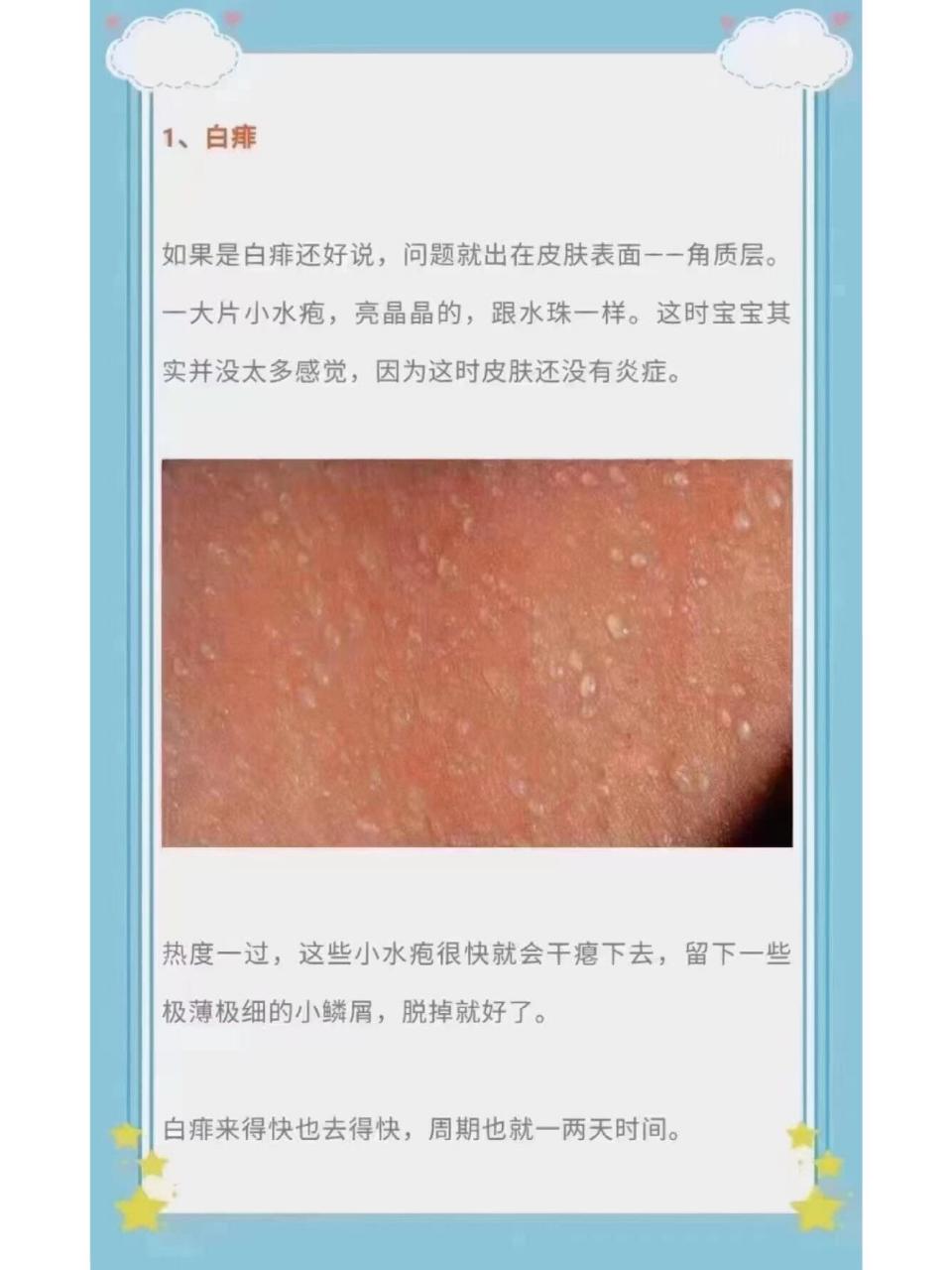 炎炎夏天到了,长痱子的宝宝注意了7215 93育儿分享 痱子分为白