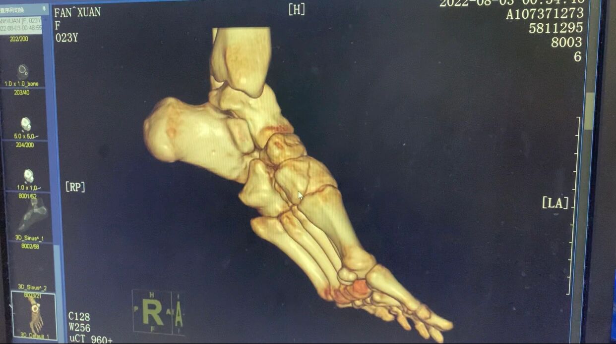 左脚内侧楔骨骨折 有够神奇