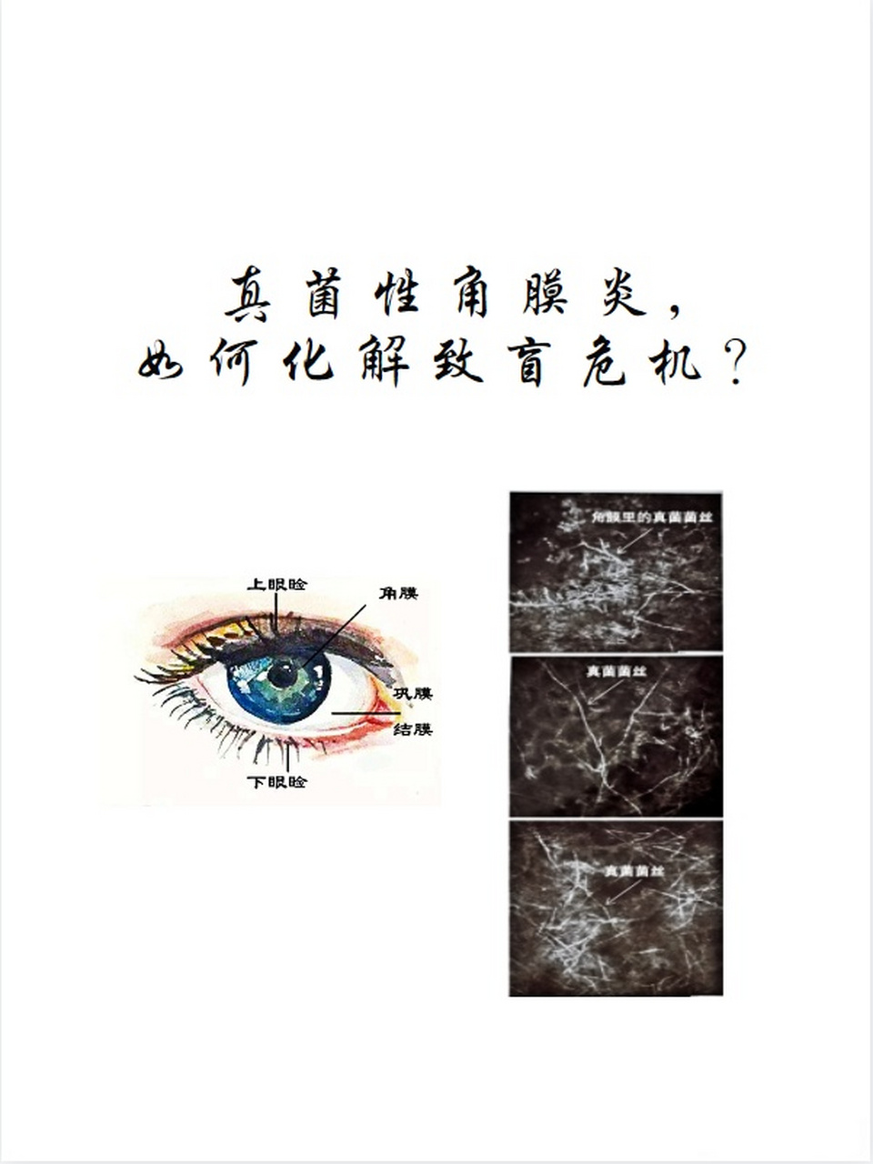 角膜炎的症状及治疗图片