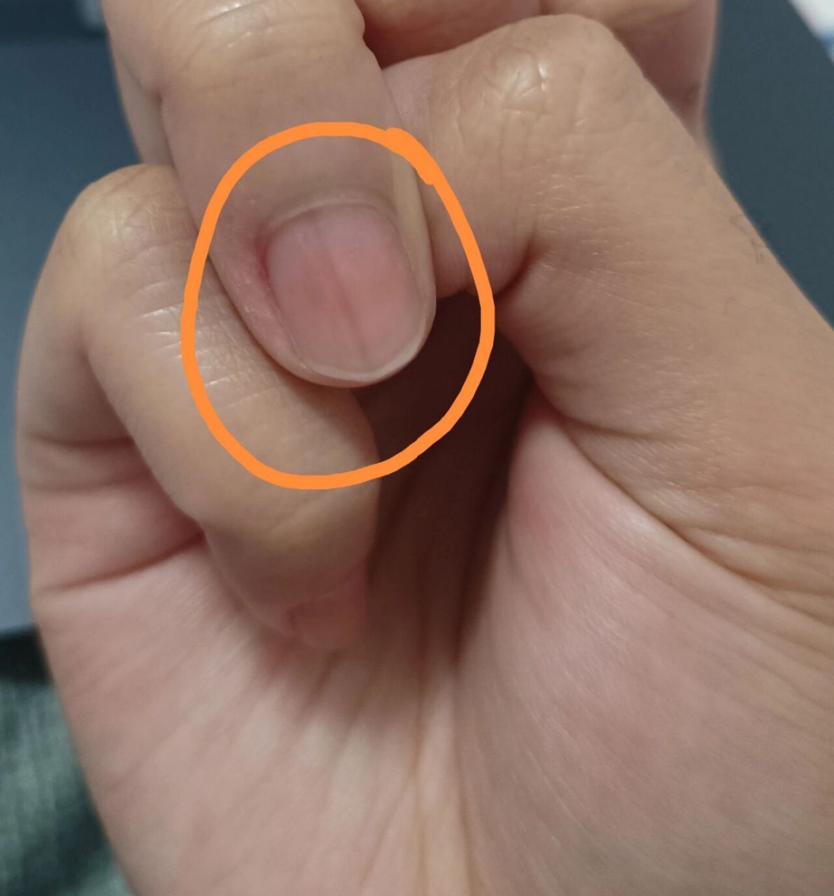 手指甲盖上面有条灰色的线是咋回事 求助!如上01!手指甲有竖纹