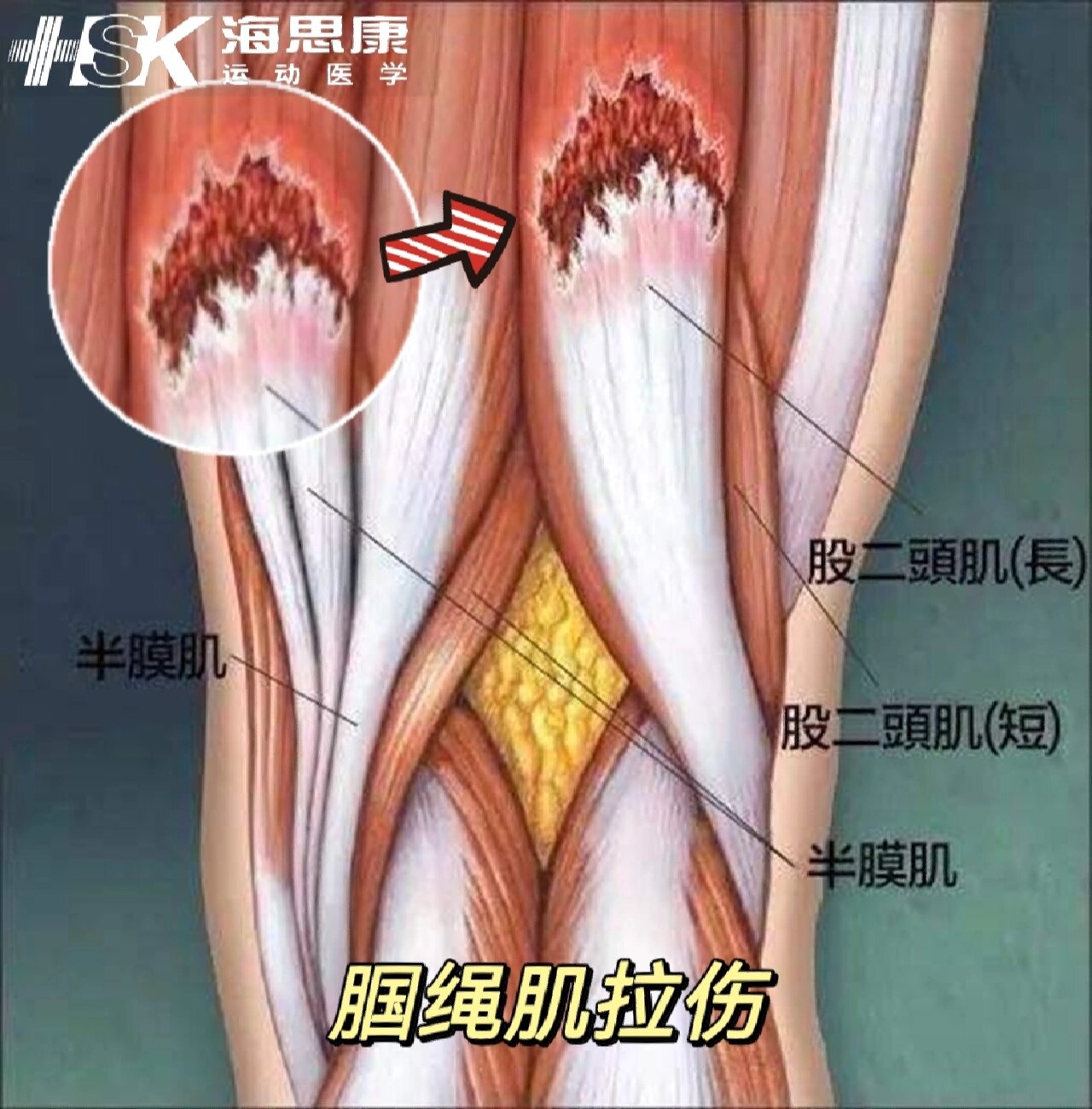 腘绳肌损伤是运动员常见的损伤,其中,最为普遍的就是腘绳肌拉伤.