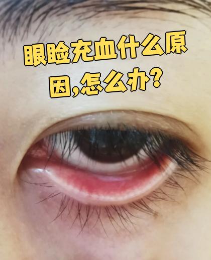 眼睛为什么充血