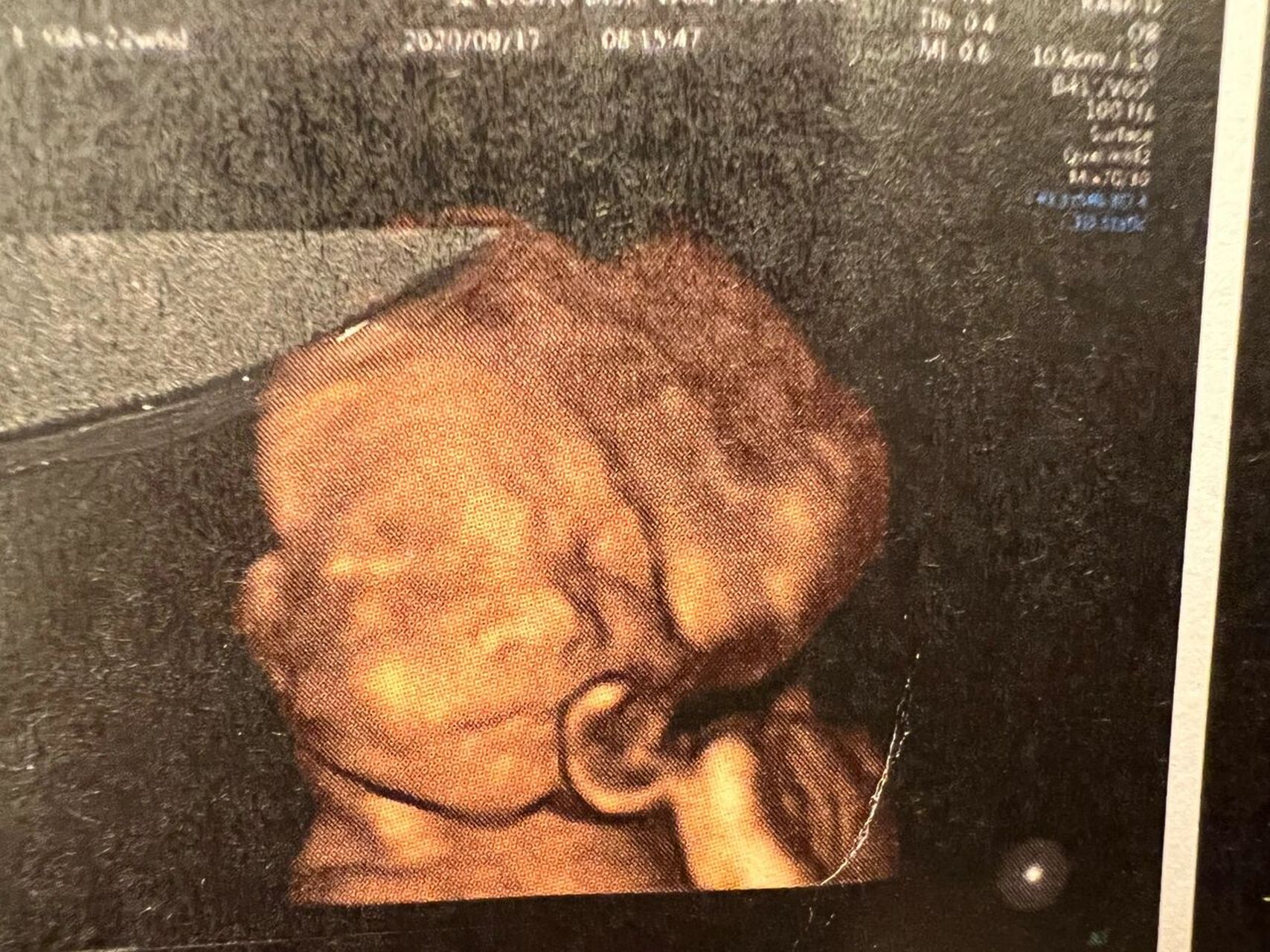 四维时被这个大鼻子吓坏了(四维图已上) 四维图里鼻子真的好大,生下来