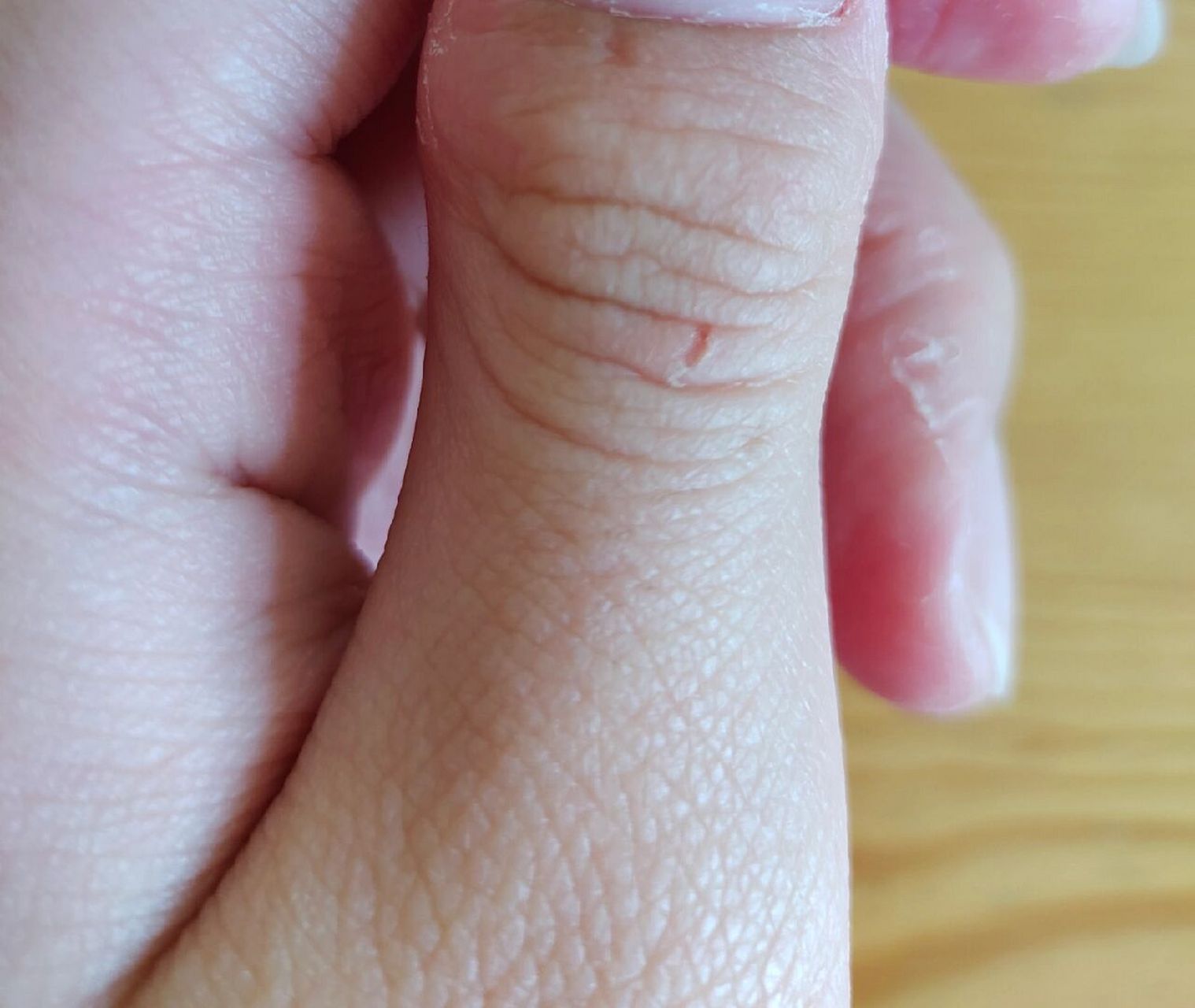 睡醒之后手上有伤口是怎么回事 经常睡醒之后左手大拇指指节就莫名