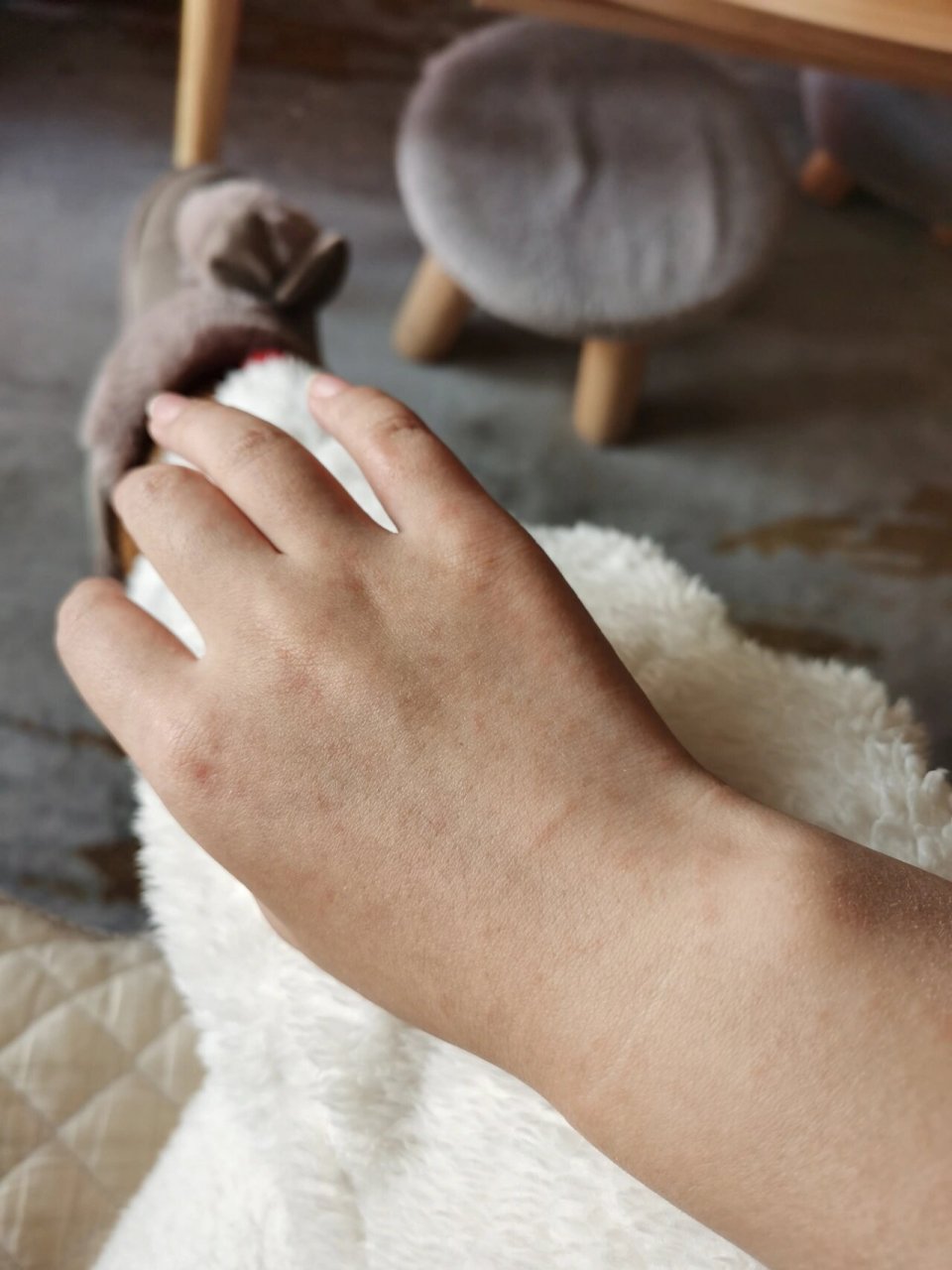 新冠引起的红疹 已经去医院了,是新冠引起的病毒疹.