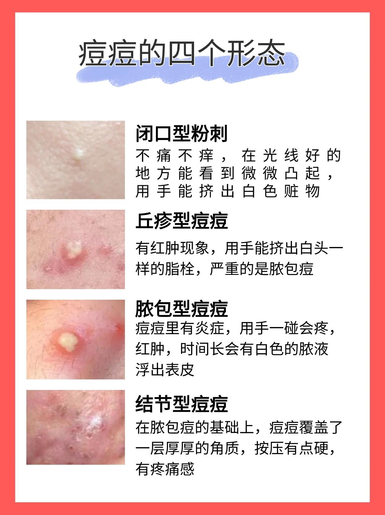 粉刺和痘痘怎么区分图片