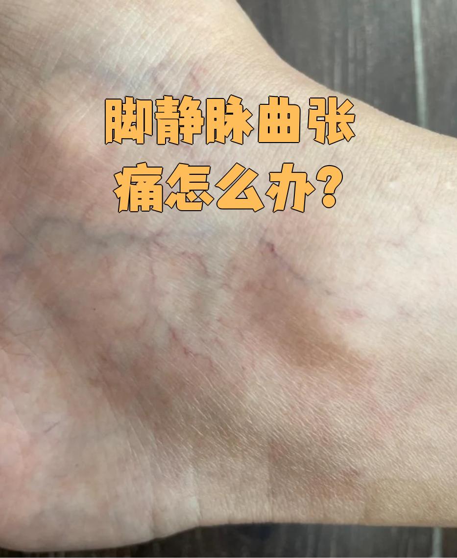 脚静脉曲张痛可以通过药物,压迫治疗和手术来缓解